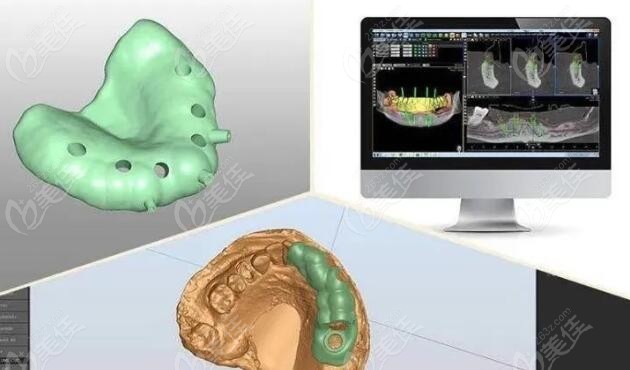 3D数字化种植牙技术