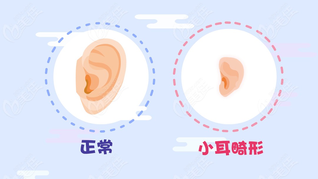 外耳再造手术可以改善小耳畸形