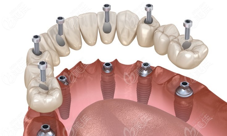 全口种植牙效果图片图片