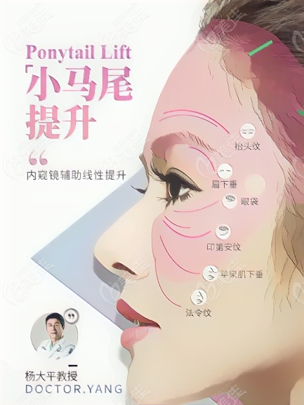 小马尾提升术的适合人群是20-40岁衰老的人