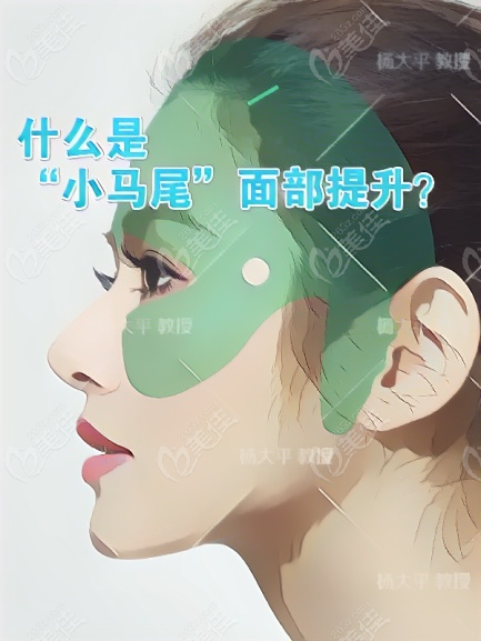 小马尾提升术是什么