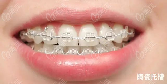 陶瓷半隐形牙套能否矫正露牙龈