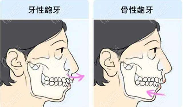 骨性龅牙和牙性龅牙导致的露牙龈