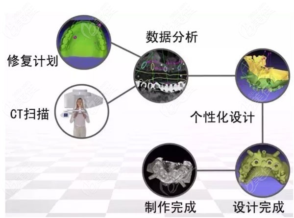 3D数字化导板种植