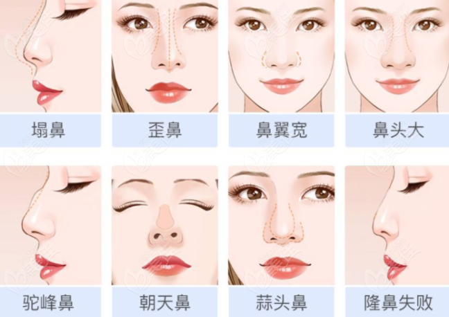 上海臻禾医疗美容杨云霞医生可以做哪些鼻子
