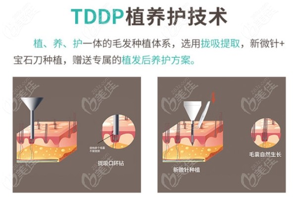 新生TDDP养植护技术优势