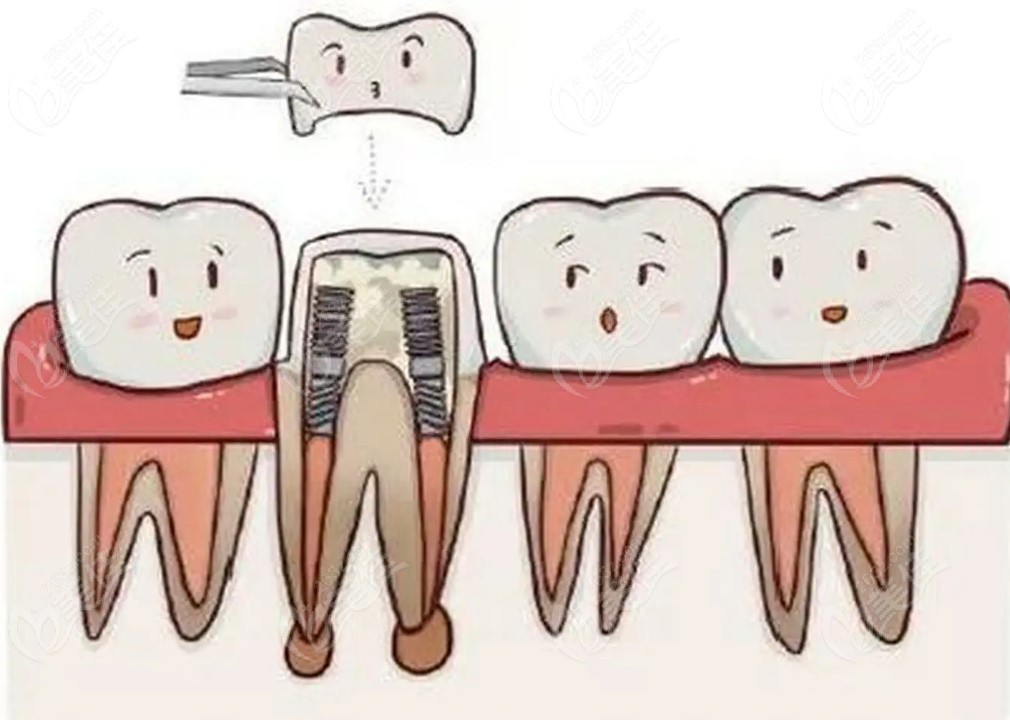 根管治疗补牙
