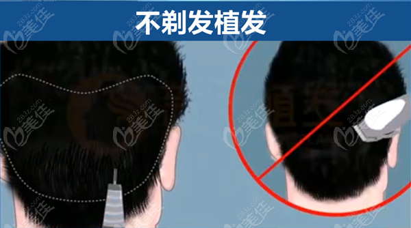 不剃发植发技术