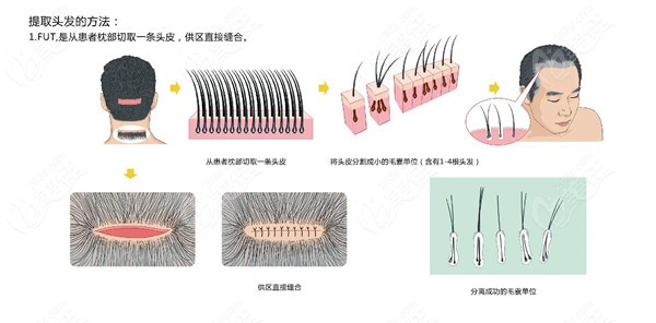 FUT隐痕植发技术操作过程