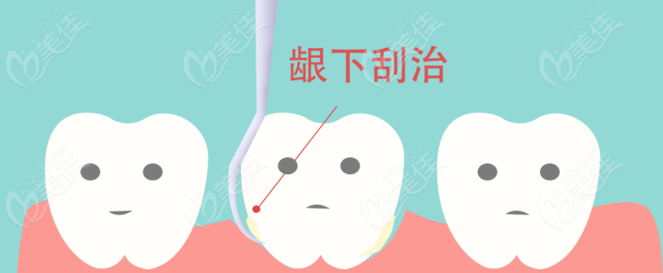 龈下刮治示意图