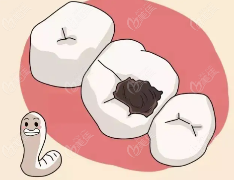 嵌体为什么会掉