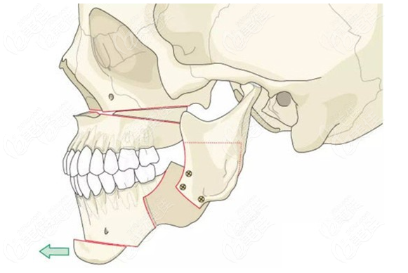 正颌手术是怎么做的