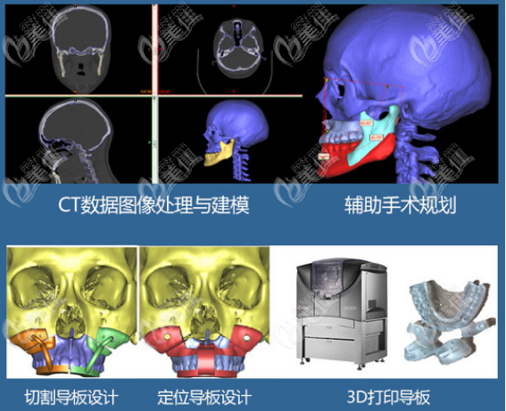 正颌外科手术好恐怖