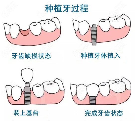 种植牙的结构详解图!图片