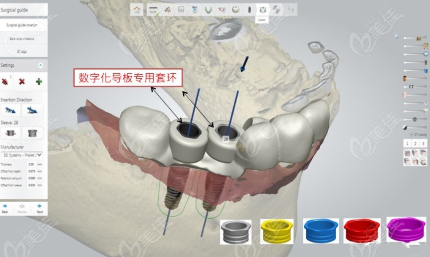 数字化种植牙模拟过程