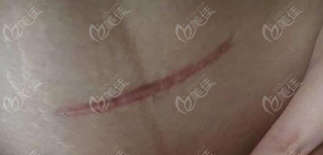 剖腹产的疤痕可以通过激光祛除
