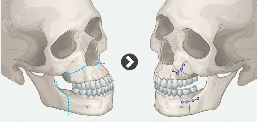 正颌手术为什么会反弹啊？做正颌手术反弹率高吗？