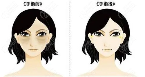 去找田永成医生做眼袋术前和术后对比图