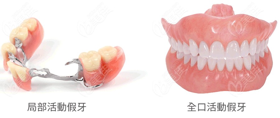 局部活动假牙和全口活动假牙