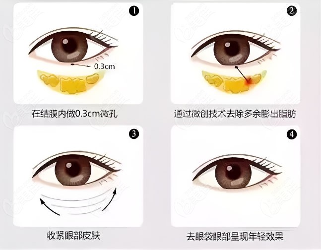 不开刀去眼袋手术原理和操作步骤过程图解
