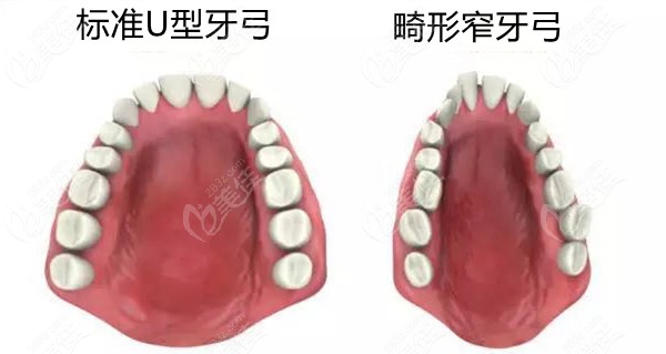 标准U型牙弓和窄牙弓对比图