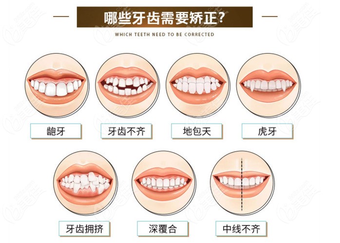 牙齿矫正适应症看看能改善哪些牙齿问题