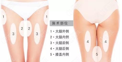 在杭州艺星做黄金微雕大腿吸脂要结合腿部区域脂肪情况来定