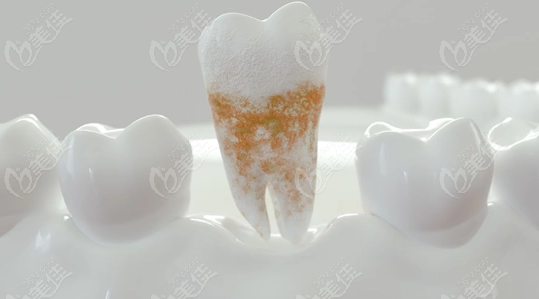 全口清创术针对的是有牙周疾病的