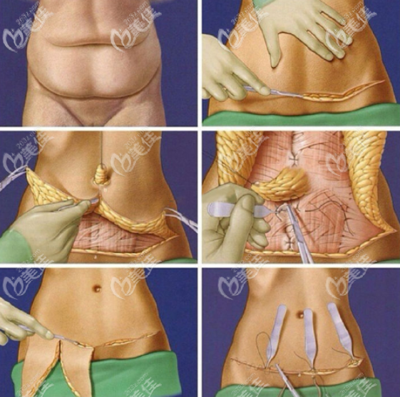 腹壁成形手术过程图示
