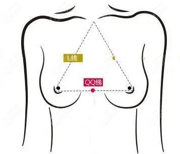 假体隆胸设计示意图