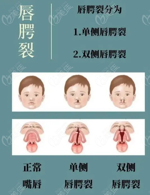 1,单侧唇裂患儿年龄需要在5个月以上,体重8公斤以上;2,双侧唇裂患儿