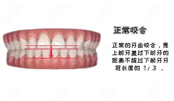 牙齿矫正三阶段调整咬合