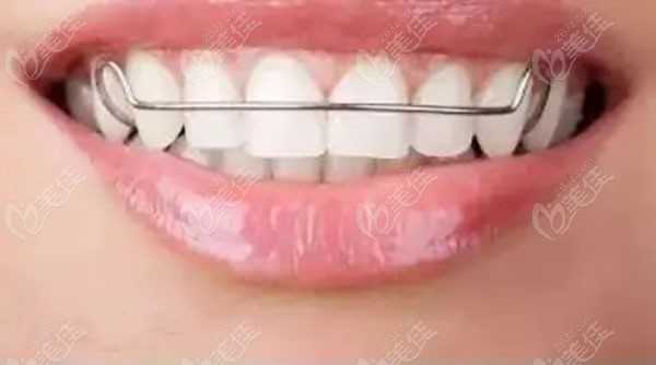 牙齿矫正四阶段戴保持器