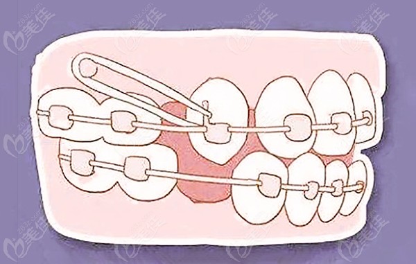 牙齿矫正比较痛苦的阶段
