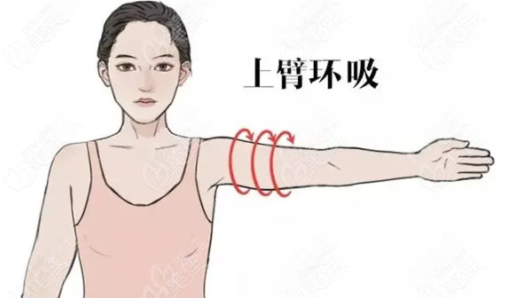 吸脂消除拜拜肉是環(huán)吸好還是普通吸脂好m.pfflawyer.com