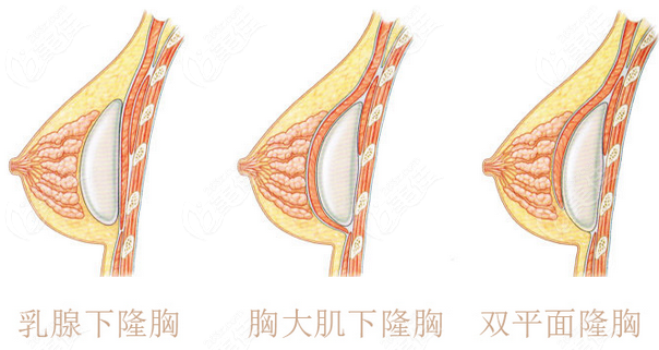 相比普通豐胸,極速豐胸手感更好