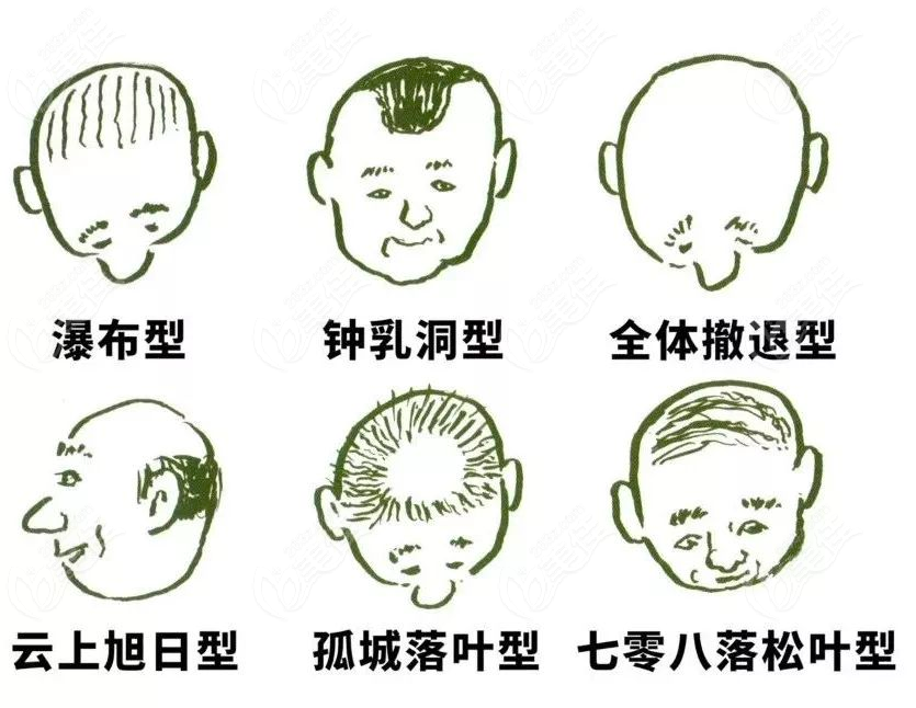 不同类型的脱发植发需求