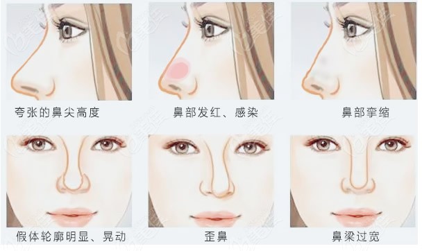 范荣杰医生可以修复的的鼻子类型