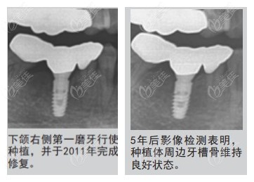 仕诺康种植牙5年后影影像对比