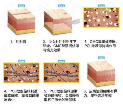 伊妍仕少女针也被称为洢莲丝,依恋诗,易丽适,依戀詩,奇迹针等,主要