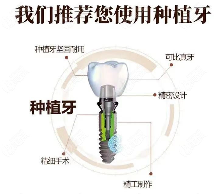 奧齒泰,美格真)——4000-8000元起/顆;美國種植系統(皓聖,傑美,百康)