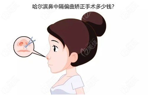 哈尔滨鼻中隔偏曲矫正手术多少钱？