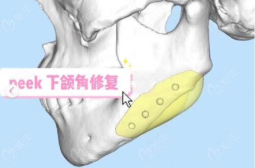 方法一:3d打印人工骨修复下颌骨方法二:自体血管化腓骨进行移植重建