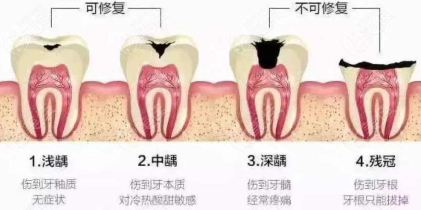 牙齿龋坏的不同程度