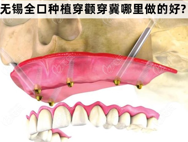 无锡全口种植穿颧穿冀