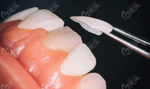 通过瓷贴面或烤全瓷牙来治疗牙齿黑三角