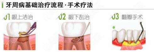 牙周治疗和牙周手术可补救牙齿正畸黑三角