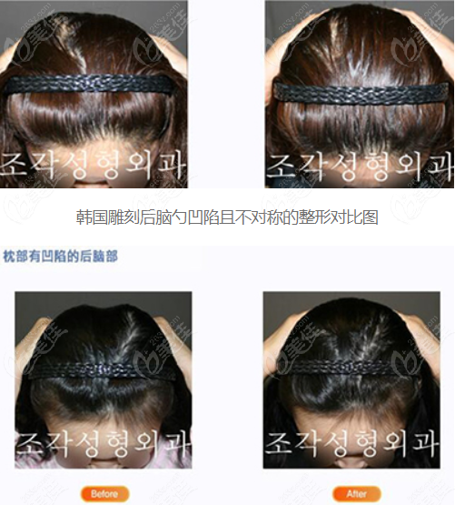韩国雕刻后脑勺填充凹陷不对称对比照片