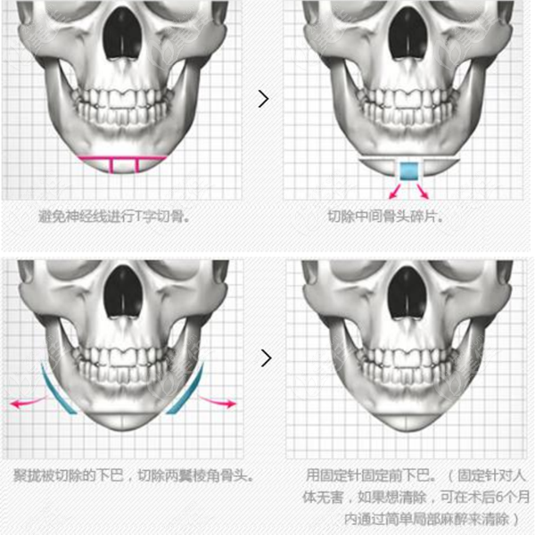 贵州下巴削骨大概要多少钱？35000元起