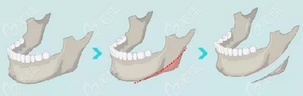 贵州磨下颌骨手术费用表在这